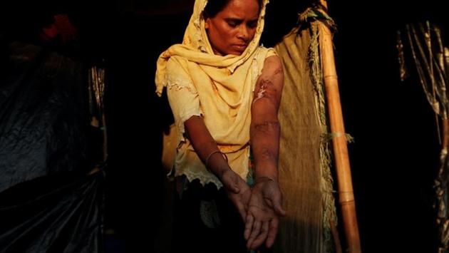 Anwara Begum, 36, poses for a photograph at Kutupalang refugee camp in Bangladesh. Sadar Hospital in Cox’s Bazar had treated 1,467 Rohingya since the exodus began for injuries including bullet wounds, broken bones and cuts inflicted by knives or machetes. (Jorge Silva / REUTERS) Anwara Begum, 36, poses for a photograph at Kutupalang refugee camp in Bangladesh. Sadar Hospital in Cox’s Bazar had treated 1,467 Rohingya since the exodus began for injuries including bullet wounds, broken bones and cuts inflicted by knives or machetes. (Jorge Silva / REUTERS)