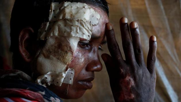 Momtaz Begum, 30, shows her injuries at the Balukhali refugee camp in Bangladesh. The UN rights agency has called the crisis “a textbook example of ethnic cleansing”. Myanmar, an overwhelmingly Buddhist nation has rejected such charges, saying its forces targeted insurgents, whom they accuse of setting the fires and attacking civilians. (Jorge Silva / REUTERS) Momtaz Begum, 30, shows her injuries at the Balukhali refugee camp in Bangladesh. The UN rights agency has called the crisis “a textbook example of ethnic cleansing”. Myanmar, an overwhelmingly Buddhist nation has rejected such charges, saying its forces targeted insurgents, whom they accuse of setting the fires and attacking civilians. (Jorge Silva / REUTERS)