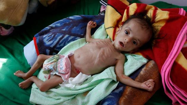 A malnourished Yemeni child receives treatment at a hospital in the capital Sanaa. (AFP Photo) A malnourished Yemeni child receives treatment at a hospital in the capital Sanaa. (AFP Photo)