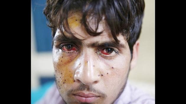 An injured pellet victim at the SMHS hosipital in Srinagar. The hospital that receives only critical patients from 10 districts and caters to the city patients, was overwhelmed with cases of pellet injuries since July 9, a day after Burhan Wani was killed. (Waseem Andrabi / HT Photo) An injured pellet victim at the SMHS hosipital in Srinagar. The hospital that receives only critical patients from 10 districts and caters to the city patients, was overwhelmed with cases of pellet injuries since July 9, a day after Burhan Wani was killed. (Waseem Andrabi / HT Photo)