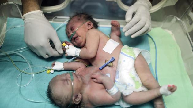 This file photo taken on October 22, 2017 shows then one-day-old Palestinian conjoined twins in an incubator at the nursery at the al-Shifa Hospital in Gaza City. The conjoined twins born in the blockaded Palestinian enclave were separated in a "successful" surgery in Riyadh on January 8, 2018, the state-run Saudi Press Agency said in a statement. (AFP File Photo) This file photo taken on October 22, 2017 shows then one-day-old Palestinian conjoined twins in an incubator at the nursery at the al-Shifa Hospital in Gaza City. The conjoined twins born in the blockaded Palestinian enclave were separated in a "successful" surgery in Riyadh on January 8, 2018, the state-run Saudi Press Agency said in a statement. (AFP File Photo)