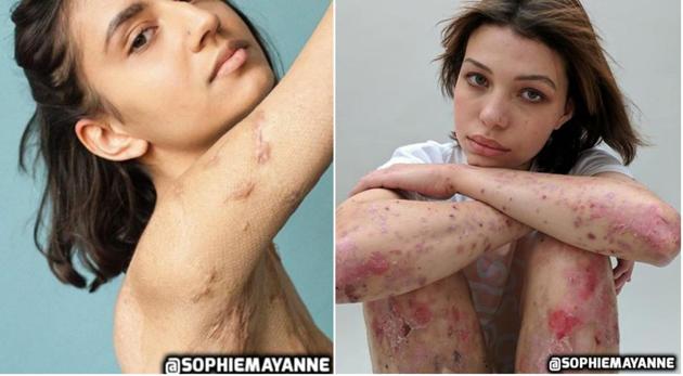 London-based photographer Sophie Mayenne’s project ‘Behind the Scars’ celebrates people’s scars and the stories behind them. (Sophie Mayenne/Instagram) London-based photographer Sophie Mayenne’s project ‘Behind the Scars’ celebrates people’s scars and the stories behind them. (Sophie Mayenne/Instagram)