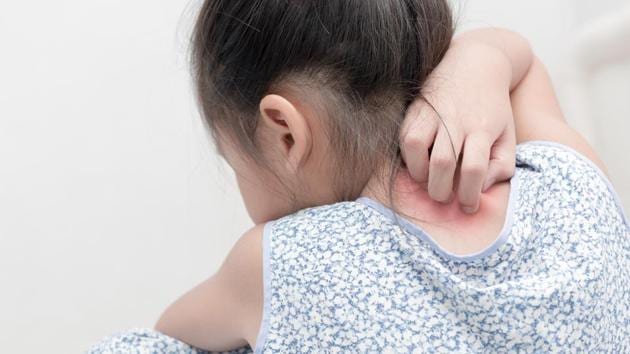 Children with atopic dermatitis (AD), a type of eczema of the skin, show an increased risk of developing asthma later in life.(Shutterstock)