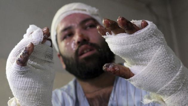 Hossaini survived the inferno with severe burns — but the wounds that won’t heal are the ones on the inside, the hopelessness he now lives with and the realization that nowhere is safe, not even culture centers or places of worship. (Rahmat Gul / AP) 