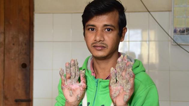 This picture taken on January 25, 2018 shows ‘Tree Man’ Abul Bajandar showing his palms where the warts are regrowing at Dhaka Medical College Hospital in Dhaka. (AFP Photo) This picture taken on January 25, 2018 shows ‘Tree Man’ Abul Bajandar showing his palms where the warts are regrowing at Dhaka Medical College Hospital in Dhaka. (AFP Photo)