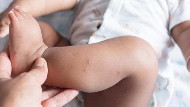 It has been found that cetirizine - common allergy medication - is safe, well-tolerated, and may reduce relapses in patients with neuromyelitis optica (NMO).(Shutterstock)