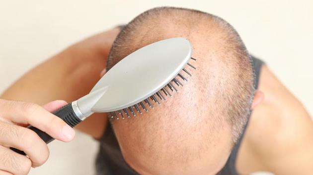 The study used two kinds of cells placed in silicone containers to cultivate “hair follicle germs” -- the sources of the tiny organs that grow and sustain hair.(Shutterstock)