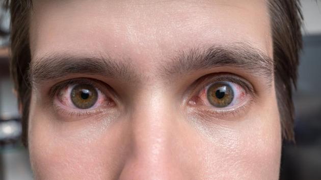 The symptoms of retinal diseases may vary depending on the type of retinal disorder. However, most of the symptoms overlap each other or are common in various diseases. (Shutterstock) The symptoms of retinal diseases may vary depending on the type of retinal disorder. However, most of the symptoms overlap each other or are common in various diseases. (Shutterstock)