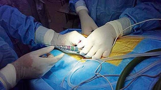 The minimally invasive spinal endoscopy needs a smaller incision. There is also minimal dissection of skin, muscle and bones.(HT Photo)