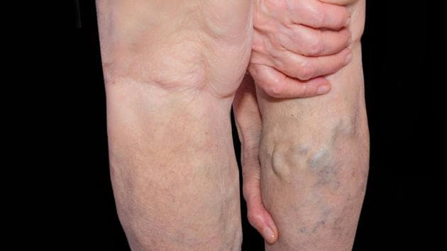 A study found people with varicose veins were at a five times increased risk of developing a deep venous thrombosis (DVT) -- a clot in the legs which can lead to amputation or even death