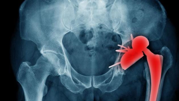 While dislocations only occur in about 1 % of patients after hip replacement, certain individuals may be at a higher risk.(Shutterstock)
