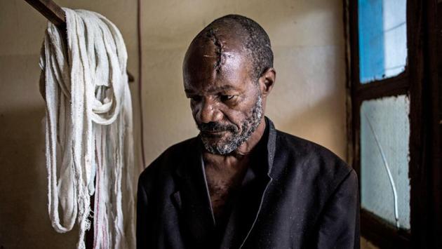 Bawma Yoame, 56, recovers after an attack left him severely wounded with multiple lacerations to his head. Hema and Lendu groups have a long history of violence but in the late 90s and early 2000s their fight became a broader, brutal battle stoked by Rwanda and Uganda, eager to seize gold, diamond and timber along with influence in a wider war that played out in DR Congo. (John Wessels / AFP) Bawma Yoame, 56, recovers after an attack left him severely wounded with multiple lacerations to his head. Hema and Lendu groups have a long history of violence but in the late 90s and early 2000s their fight became a broader, brutal battle stoked by Rwanda and Uganda, eager to seize gold, diamond and timber along with influence in a wider war that played out in DR Congo. (John Wessels / AFP)