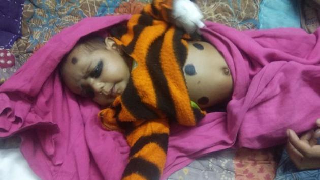 The baby after being treated at a government hospital. (HT Photo) The baby after being treated at a government hospital. (HT Photo)