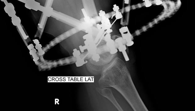 At the end of surgery, the x-ray measurements and strut caliber readings were fed into a special computer programme which gave out a prescription of strut adjustments over four weeks.(HT PHOTO)