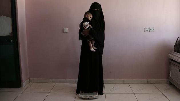 When the doctor told Mizrah that her malnutrition could be fatal, she trembled. Cigarette burns mark her baby’s belly. Desperate, the father had turned to a Yemeni folk cure called “maysam,” — using burns to expel evil spirits. “I don’t know what is right… He was playful and doing fine then he started to get sick and stopped breastfeeding and playing,” Mizrah said. (Nariman El-Mofty / AP) When the doctor told Mizrah that her malnutrition could be fatal, she trembled. Cigarette burns mark her baby’s belly. Desperate, the father had turned to a Yemeni folk cure called “maysam,” — using burns to expel evil spirits. “I don’t know what is right… He was playful and doing fine then he started to get sick and stopped breastfeeding and playing,” Mizrah said. (Nariman El-Mofty / AP)
