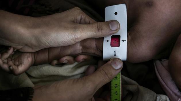 Staff carry out a malnourishment test at a hospital in Mocha. The hospital has seen 600 malnutrition cases over the past 10 months and has been short on supplies lacking even pain relievers for headaches. Prolonged malnutrition causes the body to lose its stock of carbohydrates, fats, and proteins. The brain struggles to find energy, the heart shrinks, and the skin cracks, prone to infections. (Nariman El-Mofty / AP) Staff carry out a malnourishment test at a hospital in Mocha. The hospital has seen 600 malnutrition cases over the past 10 months and has been short on supplies lacking even pain relievers for headaches. Prolonged malnutrition causes the body to lose its stock of carbohydrates, fats, and proteins. The brain struggles to find energy, the heart shrinks, and the skin cracks, prone to infections. (Nariman El-Mofty / AP)