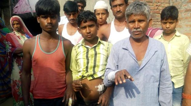 Chhotu, his father Lokai and brother Ghanshyam were attacked by feral dogs in Sitapur’s Laharpur on Sunday.(HT PHOTO)