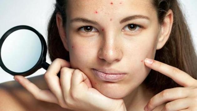 Do not squeeze your pimples. This usually leads to further inflammation, which makes the acne look worse and last longer.(Shutterstock)