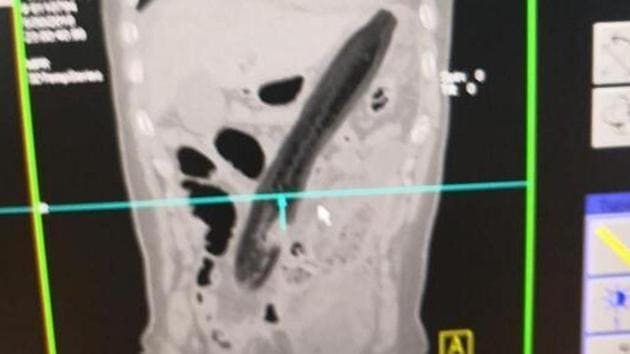 The 50-year-old man shoved a 30-cm eggplant up his anus after suffering for two days, Shanghaiist reported.(Knews/ weibo) The 50-year-old man shoved a 30-cm eggplant up his anus after suffering for two days, Shanghaiist reported.(Knews/ weibo)