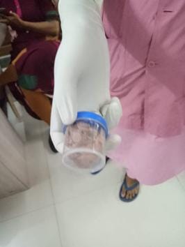 A hospital staff shows the piece of gauze that was removed from the woman's abdomen on Saturday.(HT photo) A hospital staff shows the piece of gauze that was removed from the woman's abdomen on Saturday.(HT photo)