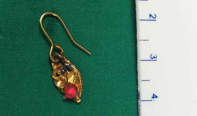 No surgery or tracheostomy was required to extract the earring.(HT photo)