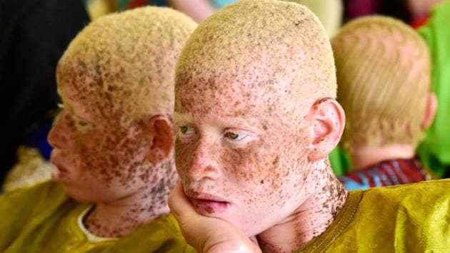 Senegalese albino people attend the International Albinism Awareness Day, at the cultural centre Douta Seck in Dakar, Senegal. (Seyllou / AFP) Senegalese albino people attend the International Albinism Awareness Day, at the cultural centre Douta Seck in Dakar, Senegal. (Seyllou / AFP)