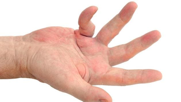 The new study gives hope to people suffering from this disabling condition, who currently have to just wait for their situation to deteriorate, and then undergo surgery.(Shutterstock) The new study gives hope to people suffering from this disabling condition, who currently have to just wait for their situation to deteriorate, and then undergo surgery.(Shutterstock)