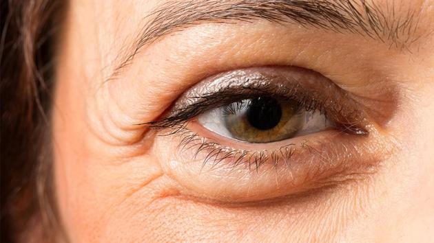 Kidney disease warning signs might include persistent puffiness around the eyes. (Shutterstock)