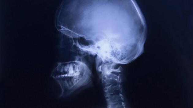Doctors found one needle at the back of the girl’s throat and eight near the food pipe after an x-ray. (Shutterstock/Representative image) Doctors found one needle at the back of the girl’s throat and eight near the food pipe after an x-ray. (Shutterstock/Representative image)