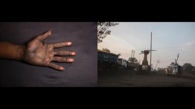 Left: Vimlesh Sawhney’s hand, Chilkadand, Right: Company logo bearing a fist at the coal truck depot of NCL Jayant Coal Mines. “Look what my hands have become! When I come home after driving, I wash my hands repeatedly but within minutes, they’re the same. All of us who work in the mines cough constantly. Whatever I’m earning goes into medicines anyway. My future? When my body stops delivering, no company will keep us” — Vimlesh Sawhney, 40, open-cast mine driver. (Ruhani Kaur)