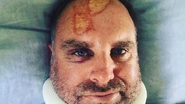 Matthew Hayden posted a photograph of his injury (Facebook/Matthew Hayden) Matthew Hayden posted a photograph of his injury (Facebook/Matthew Hayden)