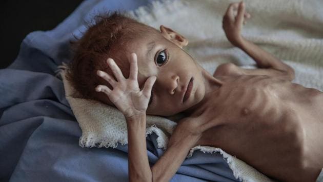 A severely malnourished boy rests on a hospital bed at the Aslam Health Center, Hajjah, Yemen. (Hani Mohammed / AP)