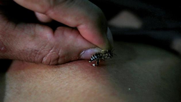 Abulhassan allows one of his bees to sting a patient suffering from rheumatoid arthritis. “These are not the only benefits,” said Abulhassan, who has no medical background. “It helps with having a better mood,” he added. (Amr Abdallah Dalsh / REUTERS) Abulhassan allows one of his bees to sting a patient suffering from rheumatoid arthritis. “These are not the only benefits,” said Abulhassan, who has no medical background. “It helps with having a better mood,” he added. (Amr Abdallah Dalsh / REUTERS)