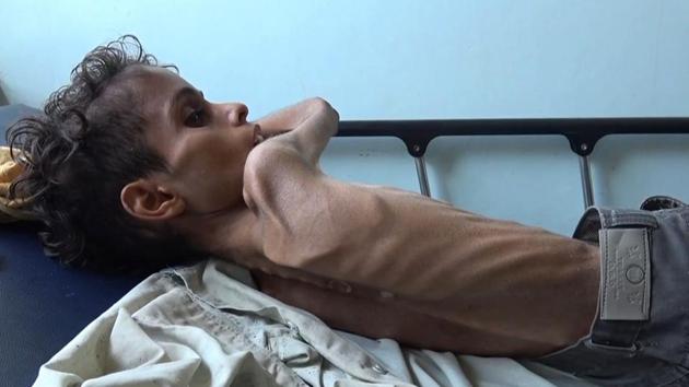 10 year-old Ghazi Saleh lies on a bed at Al-Mudhafar hospital in Taez. Skin and bones, 10-year-old Saleh only weighs eight kilogrammes. (Mazrooq Al-Jabiry / AFP) 10 year-old Ghazi Saleh lies on a bed at Al-Mudhafar hospital in Taez. Skin and bones, 10-year-old Saleh only weighs eight kilogrammes. (Mazrooq Al-Jabiry / AFP)
