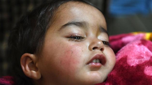 Hibba, a 20-month old baby girl, lays on a hospital bed in Srinagar, Jammu and Kashmir on November 26, 2018, after being hit in her right eye by lead pellets by government forces. Hibba was hit in Shopian district in south Kashmir on November 25, as told by her mother Masarat Jan, when they tried to flee their home filled with tear gas smoke during clashes in the area between government troops and Kashmiri youths. (Tauseef Mustafa / AFP)
