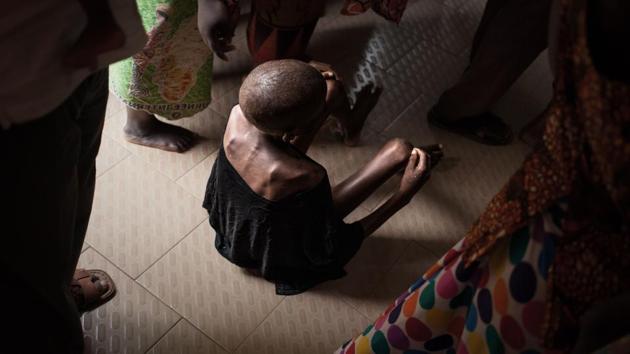 A malnourished girl sits barefoot, joints protruding, shoulder blades poking out of her skin like blades, a baggy top the only clothing to cling to her perished frame. In a doorway, another young girl stands with the round shape of her belly protruding out above her skinny legs. (Florent Vergnes / AFP) A malnourished girl sits barefoot, joints protruding, shoulder blades poking out of her skin like blades, a baggy top the only clothing to cling to her perished frame. In a doorway, another young girl stands with the round shape of her belly protruding out above her skinny legs. (Florent Vergnes / AFP)