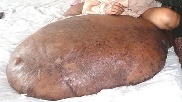 An Idaho woman who thought she was gaining weight because of menopause discovered she actually had a 50-pound tumour. (Representational Image)(AFP)