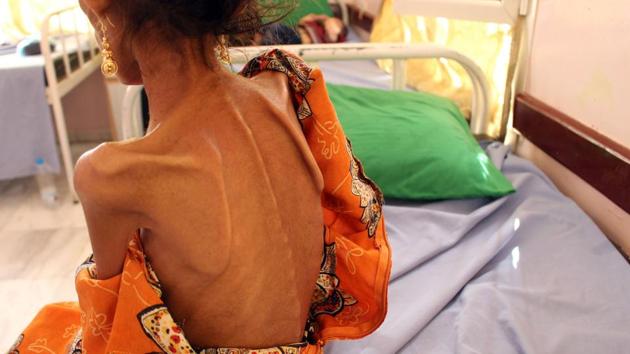 Fatima Hadi, a 12-year-old displaced Yemeni girl suffering from acute malnutrition, lies on a bed at a hospital in Yemen’s northwestern Hajjah province. The UN said this week it had reached food aid warehouses on the frontlines in Yemen, holding enough supplies to feed millions of people, for the first time since September. (Essa Ahmed / AFP) Fatima Hadi, a 12-year-old displaced Yemeni girl suffering from acute malnutrition, lies on a bed at a hospital in Yemen’s northwestern Hajjah province. The UN said this week it had reached food aid warehouses on the frontlines in Yemen, holding enough supplies to feed millions of people, for the first time since September. (Essa Ahmed / AFP)