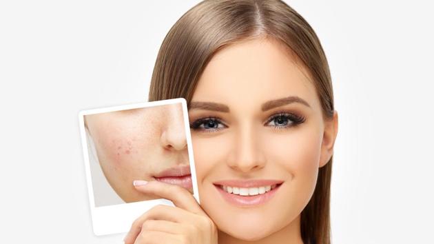 Lasers can provide 60-70% improvement in your acne scars. However, there is no such thing as 100% improvement. Regardless of the treatment, you can’t completely remove the scar.(Getty Images/iStockphoto)