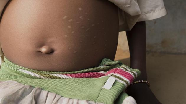 Even though the elders feared that the lack of clean water was taking a toll on the younger generation, they consulted a local faith healer, popularly known as a witch-doctor. The superstitions led to Talabati’s stomach being pierced with warm needles multiple times to relieve the pain. (WaterAid / Proneet De Kashyap)