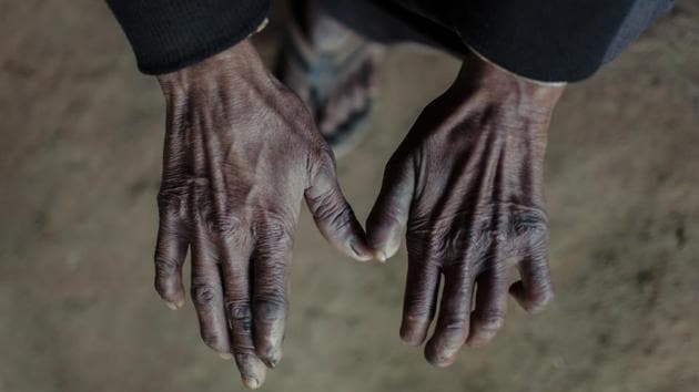 “The doctor told me that my fingers are deforming as a result of drinking groundwater polluted by leather tanneries close by,” said Rajendra Kumar (35) who lives in Sheikhpur in Kanpur district, Uttar Pradesh, home to numerous leather tanneries. (WaterAid / Poshali Goel)