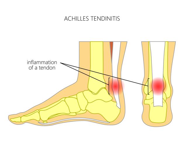 Runners who do a lot of hill running are particularly prone to Achilles tendon issues(Shutterstock)