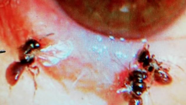 “Luckily the Halictidae didn’t attack her eye and they were removed relatively quickly,” said the doctor. (Screengrab: ctsnews) “Luckily the Halictidae didn’t attack her eye and they were removed relatively quickly,” said the doctor. (Screengrab: ctsnews)