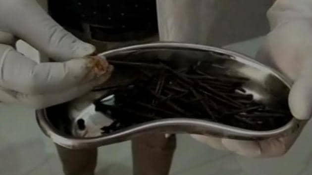 Doctors at the Bundi government hospital removed 116 iron nails, a long wire and an iron pellet from the stomach of a 42-year-old man in Rajasthan’s Bundi.(ANI/Twitter)