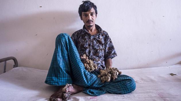 Abul Bajandar , 28, dubbed ‘Tree Man’ for massive bark-like warts on his hands and feet, sits at Dhaka Medical College Hospital in Dhaka, Bangladesh. Frustrated by his worsening condition, Bajandar said on June 24 he wants to amputate his hands to get relief from “unbearable pain”. (Munir uz Zaman / AFP) Abul Bajandar , 28, dubbed ‘Tree Man’ for massive bark-like warts on his hands and feet, sits at Dhaka Medical College Hospital in Dhaka, Bangladesh. Frustrated by his worsening condition, Bajandar said on June 24 he wants to amputate his hands to get relief from “unbearable pain”. (Munir uz Zaman / AFP)