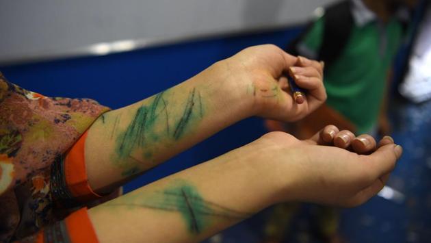 An Afghan schoolgirl shows wounds on her arms that were cut by glass at a school near the site of a Taliban car bomb attack in Kabul, a day after the deadly blast at the Defense Ministry's logistics centre that also damaged nearby buildings. (Wakil Kohsar / AFP) An Afghan schoolgirl shows wounds on her arms that were cut by glass at a school near the site of a Taliban car bomb attack in Kabul, a day after the deadly blast at the Defense Ministry's logistics centre that also damaged nearby buildings. (Wakil Kohsar / AFP)