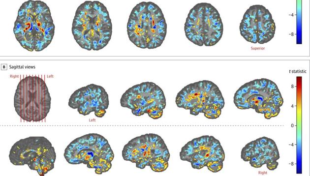 This image provided by the American Medical Association in July 2019 shows the differences between brain scans of patients, US diplomats who developed concussion-like symptoms after working in Cuba, and a control group.(AP)