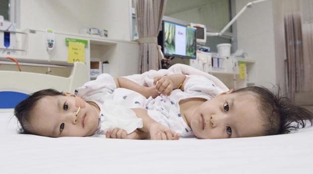 Representative image of conjoined twins. (AP Photo) Representative image of conjoined twins. (AP Photo)