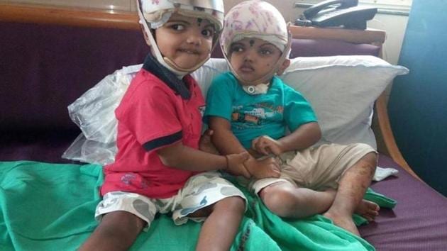 Conjoined twins Jaga and Kalia would be discharged from AIIMS Delhi for further treatment in a state government-run medical college and hospital in Odisha. (HT Photo) Conjoined twins Jaga and Kalia would be discharged from AIIMS Delhi for further treatment in a state government-run medical college and hospital in Odisha. (HT Photo)