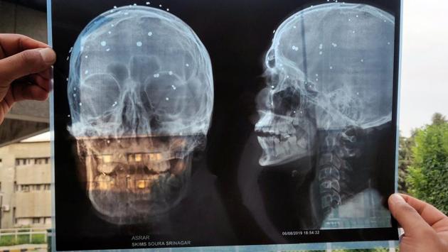 On Saturday the government appeared to row back on Dhillon’s statement, saying the cause of death was a “hard and blunt object” -- but without saying what. Khan’s father Firdous Ahmad, showing a photo and X-ray of his son’s face, said Dillon was “lying” and there were no protests the day he was hurt. “My son will not come back, but I want the world to know the truth and see what is being done to our children in Kashmir,” Ahmad told AFP. (Family Handout / AFP) 